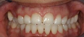 beljenje zuba