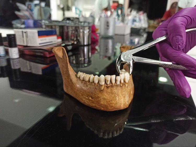 vadjenje zuba i sta raditi posle toga