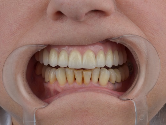 all on 4, bezmetalna keramika