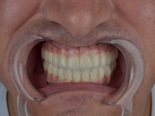 all on 4, metal keramika