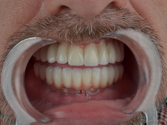 all on 4, metal keramika