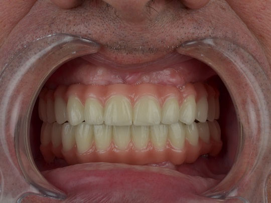 all on 4, metal keramika