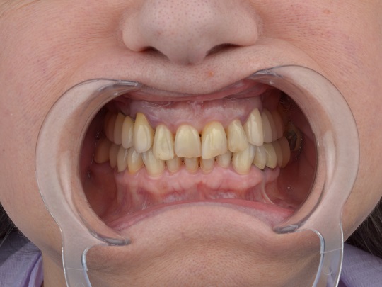 all on 4, bezmetalna keramika