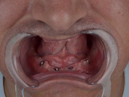 all on 4, metal keramika