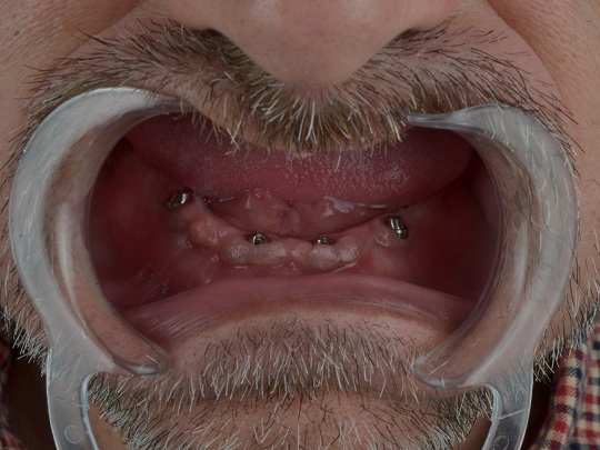 all on 4, metal keramika