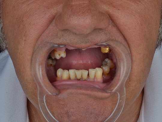 all on 4, metal keramika