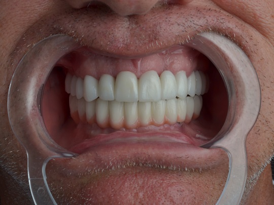 bezmetalna keramika, implanti