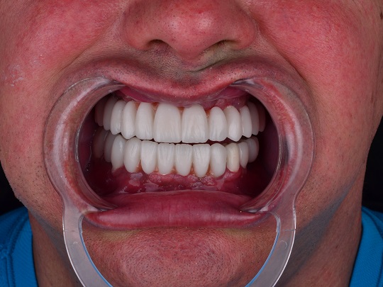 bezmetalna keramika, implanti