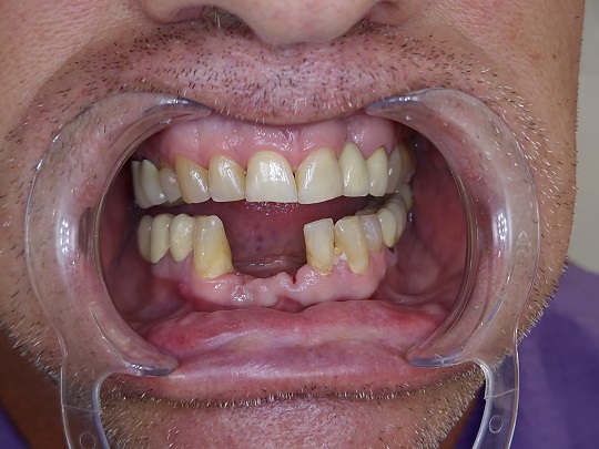 bezmetalna keramika, implanti