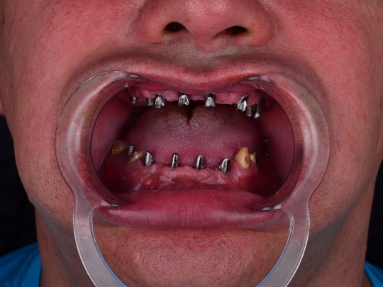 bezmetalna keramika, implanti