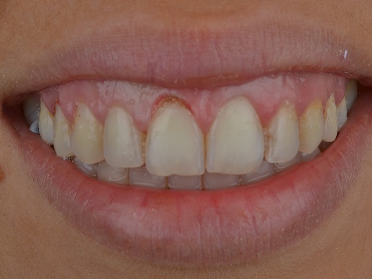 gingivektomija laser