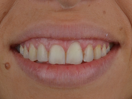 gingivektomija laser