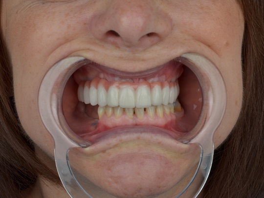 metalokeramicke krunice