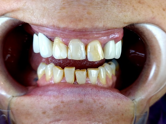 metalokeramicke krunice