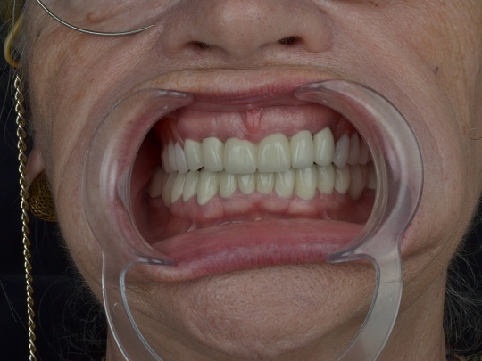 metalokeramicke krunice