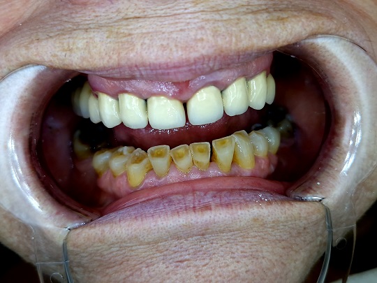 metalokeramicke krunice