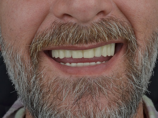 privremene krunice, all on 4