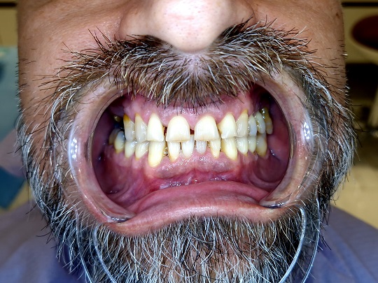 privremene krunice, all on 4